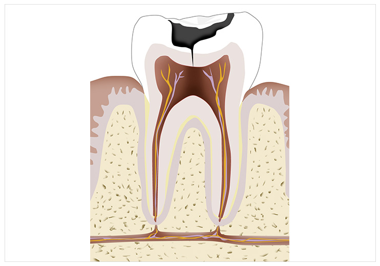 endodoncia