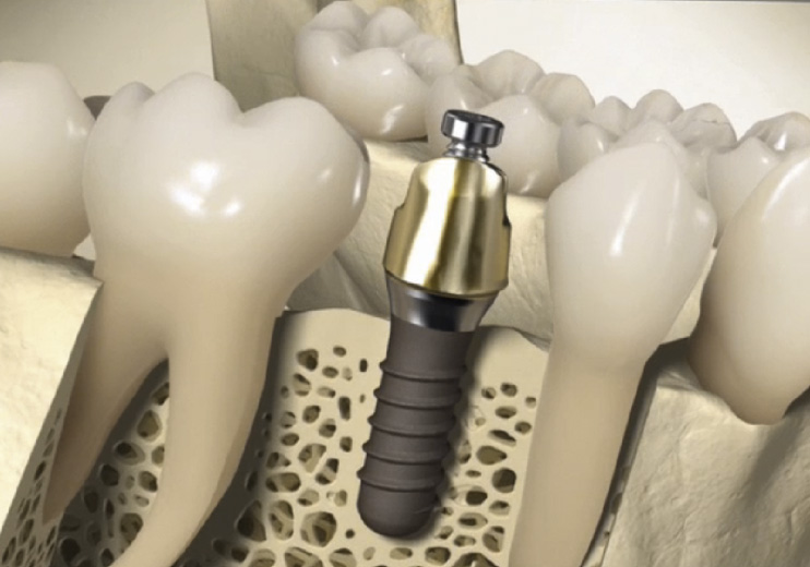 implantes dentales en CREA Odontología. Colocación y manteniento.