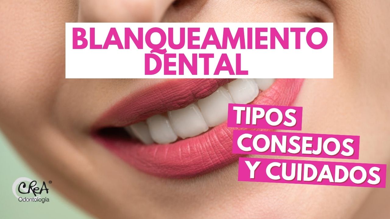 Blanqueamiento dental, tipos, consejos y cuidados