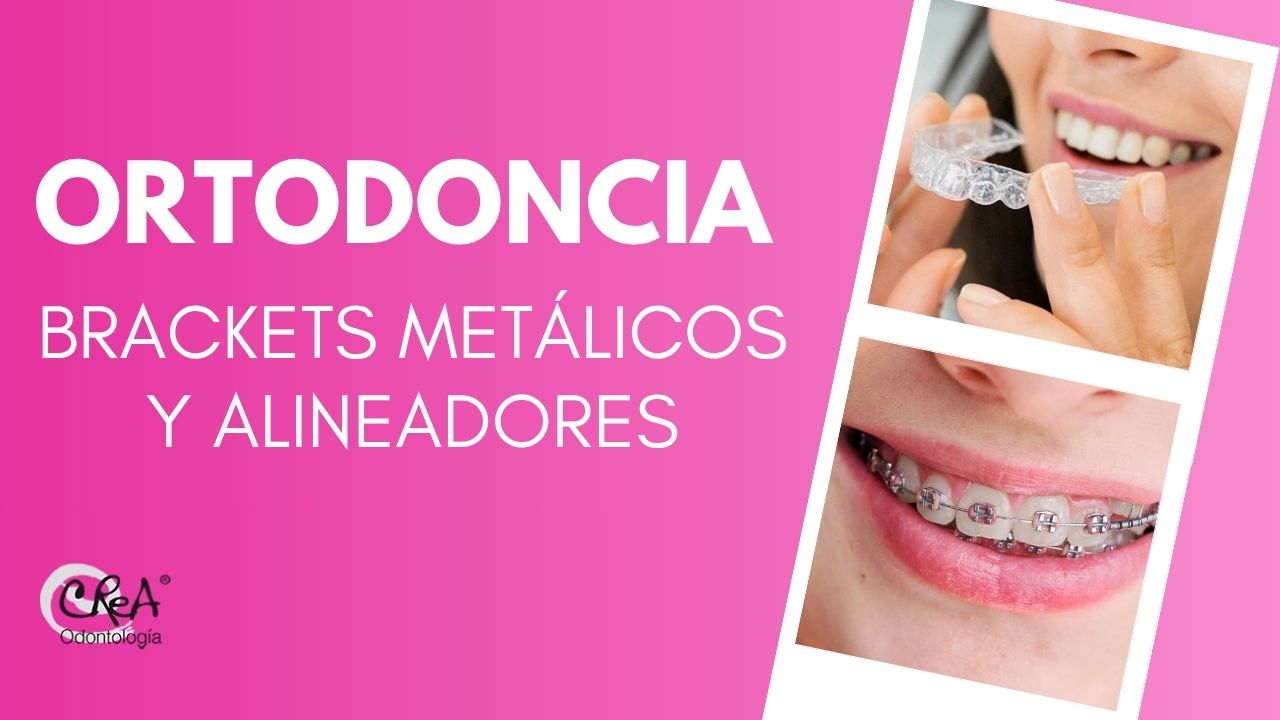 ortodoncia, diferencia entre brakets y alineadores