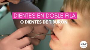 Dientes en Doble Fila o “Dientes de Tiburón”