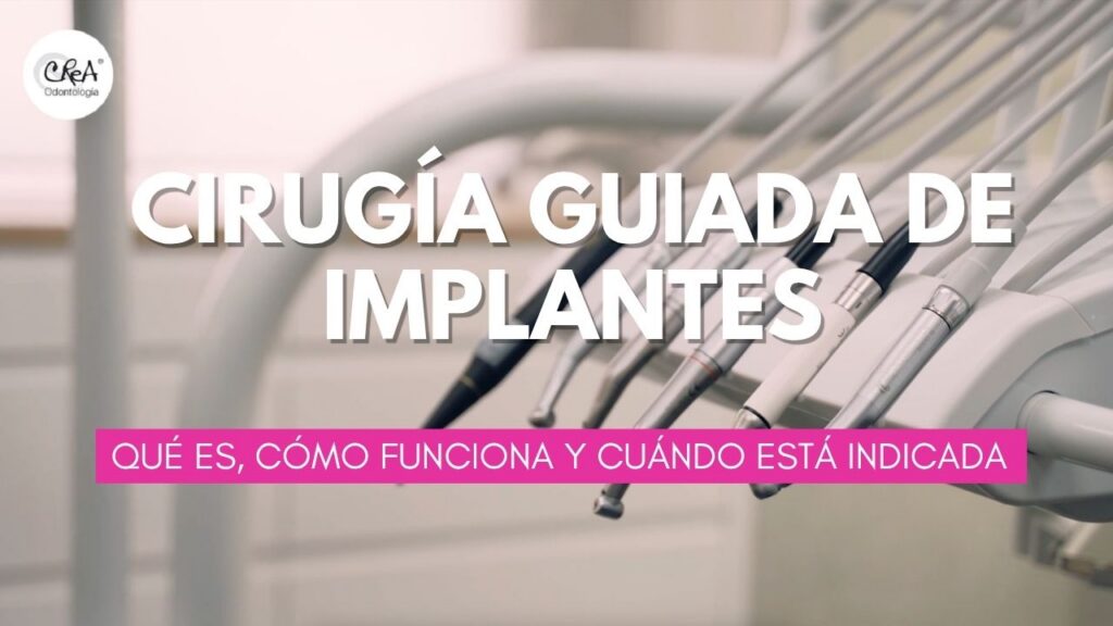 Cirugía guiada de implantes. qué es, cómo funciona y cuándo está indicada